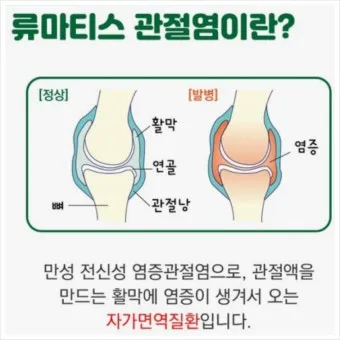 효과적인 류마티스 관절염 치료제 추천 약물 비교 가이드 2025 최신판_10