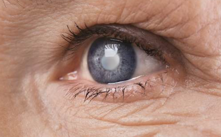 나이가많은사람의-백내장-눈