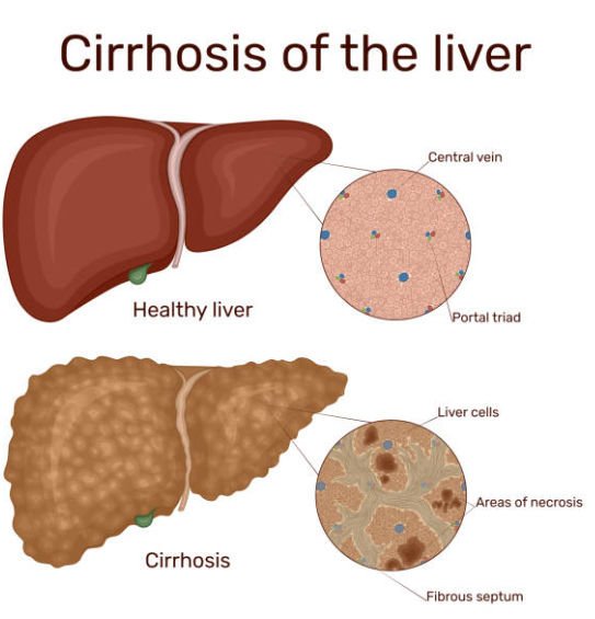 간경화증 말기와 관련된 사진