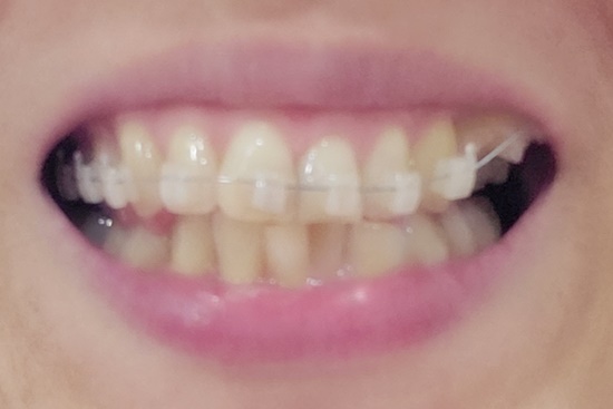 치아교정 초기사진