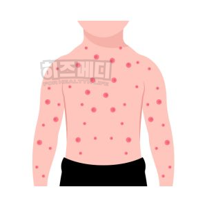 쯔쯔가무시 증상
