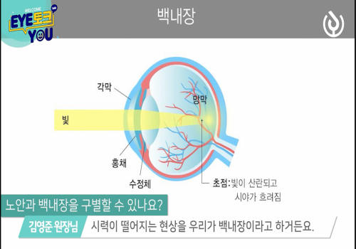 백내장 증상