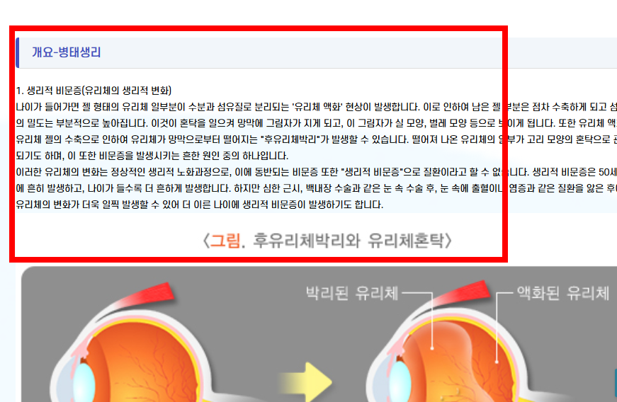 비문증 치료방법 알아보기