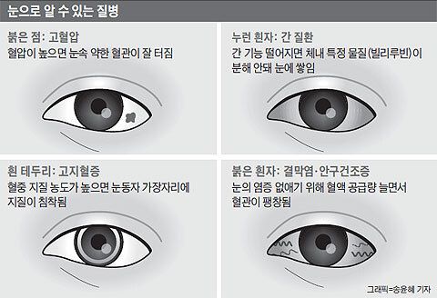 눈에 생기는 이 점들...치매 신호?