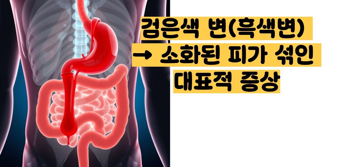 위장관 출혈 증상