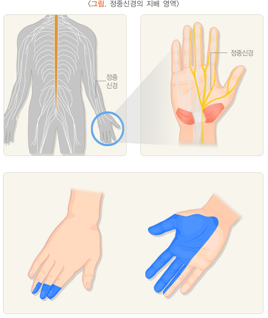 손목터널증후군(수근관증후군) 관련 이미지