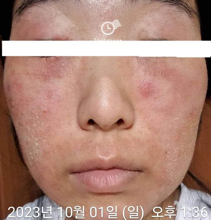 스테로이드 리바운드