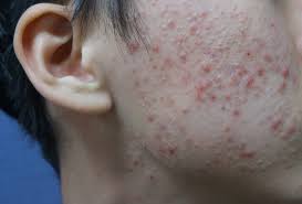 지루성 피부염 완치하려면