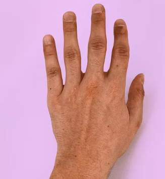 피부 건조증 진단기준 치료방법 합병증 관리