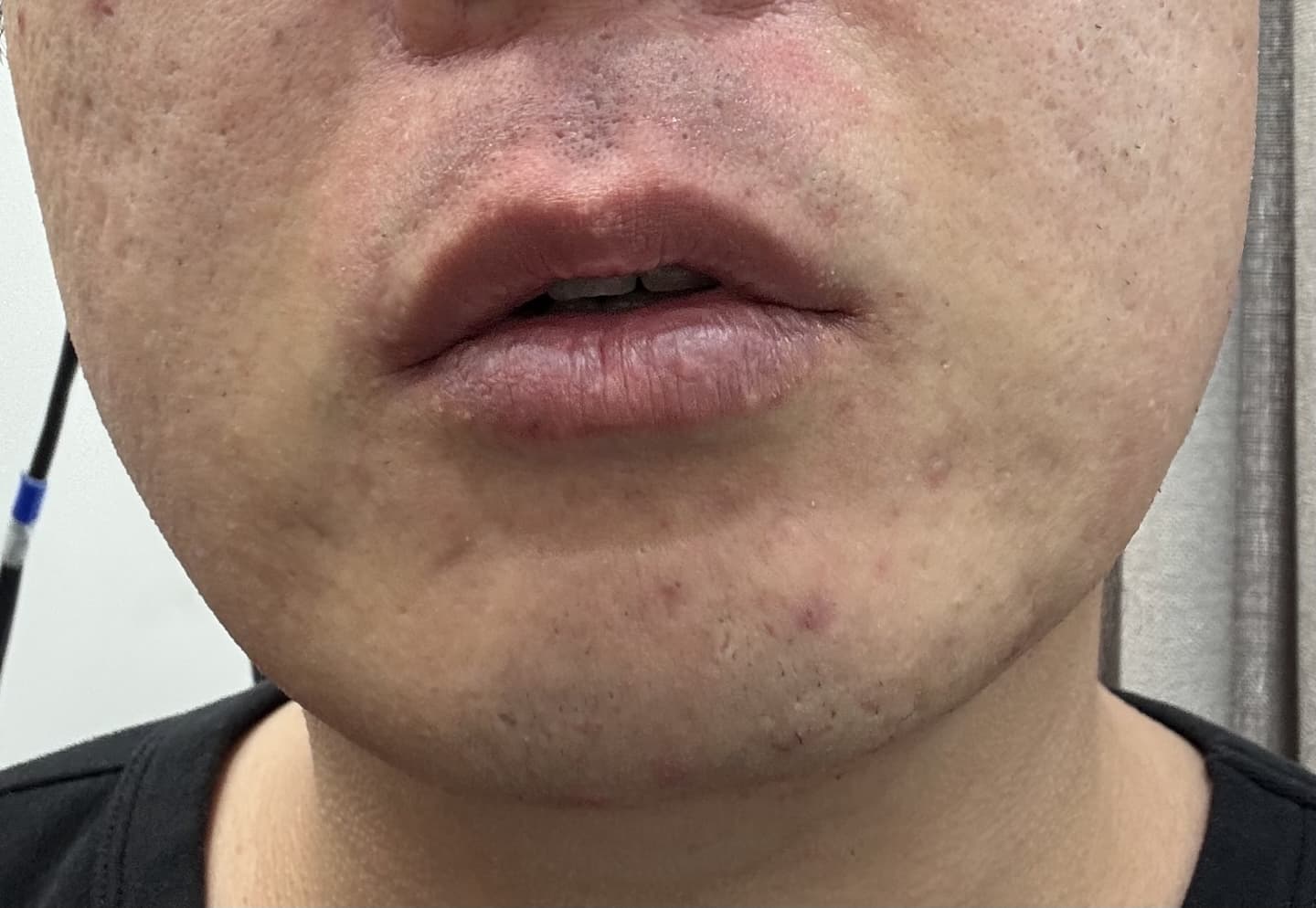 남자_수염_레이저_제모_전후_비교