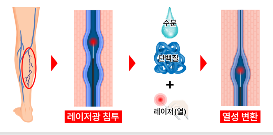 하지정맥류