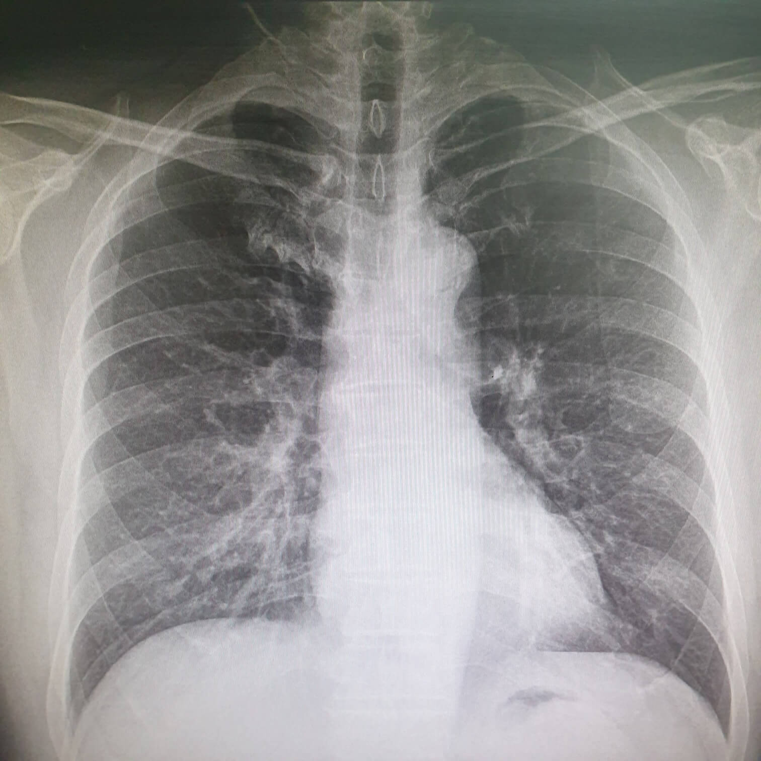 흉부 X-ray 