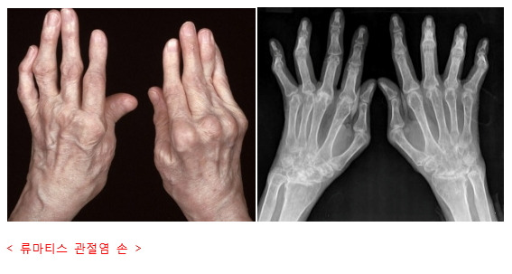 류마티스관절염 초기증상