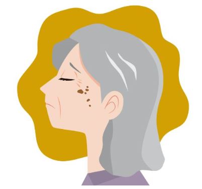 검버섯-제거크림-검버섯-없애는-방법