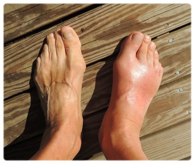 발등이 아픈 이유