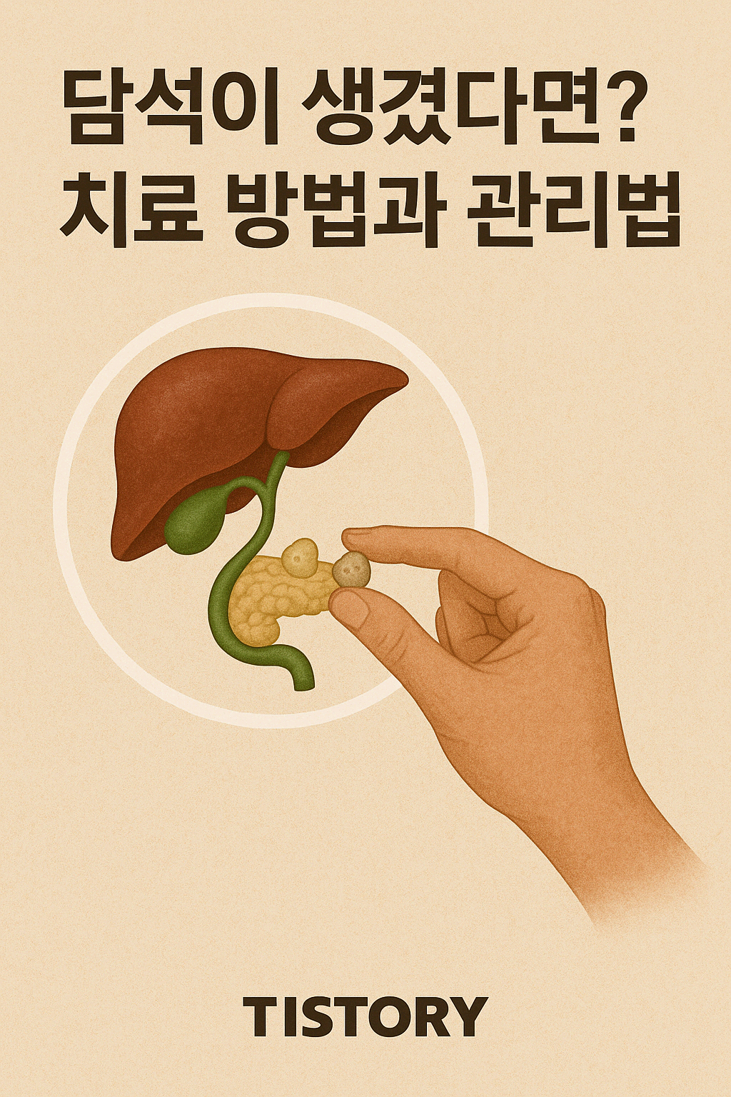 담석이 생겼다면? 치료 방법과 관리법