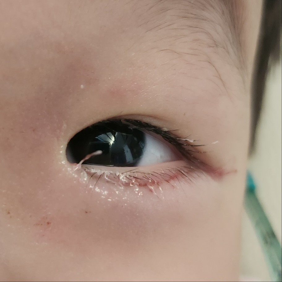 수술 1일 후 눈