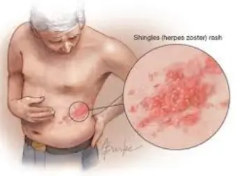 대상포진 예방접종 무료대상ㅣ초기증상 부작용