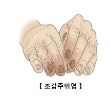 조갑주위염