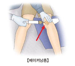 베이커씨낭종-원인