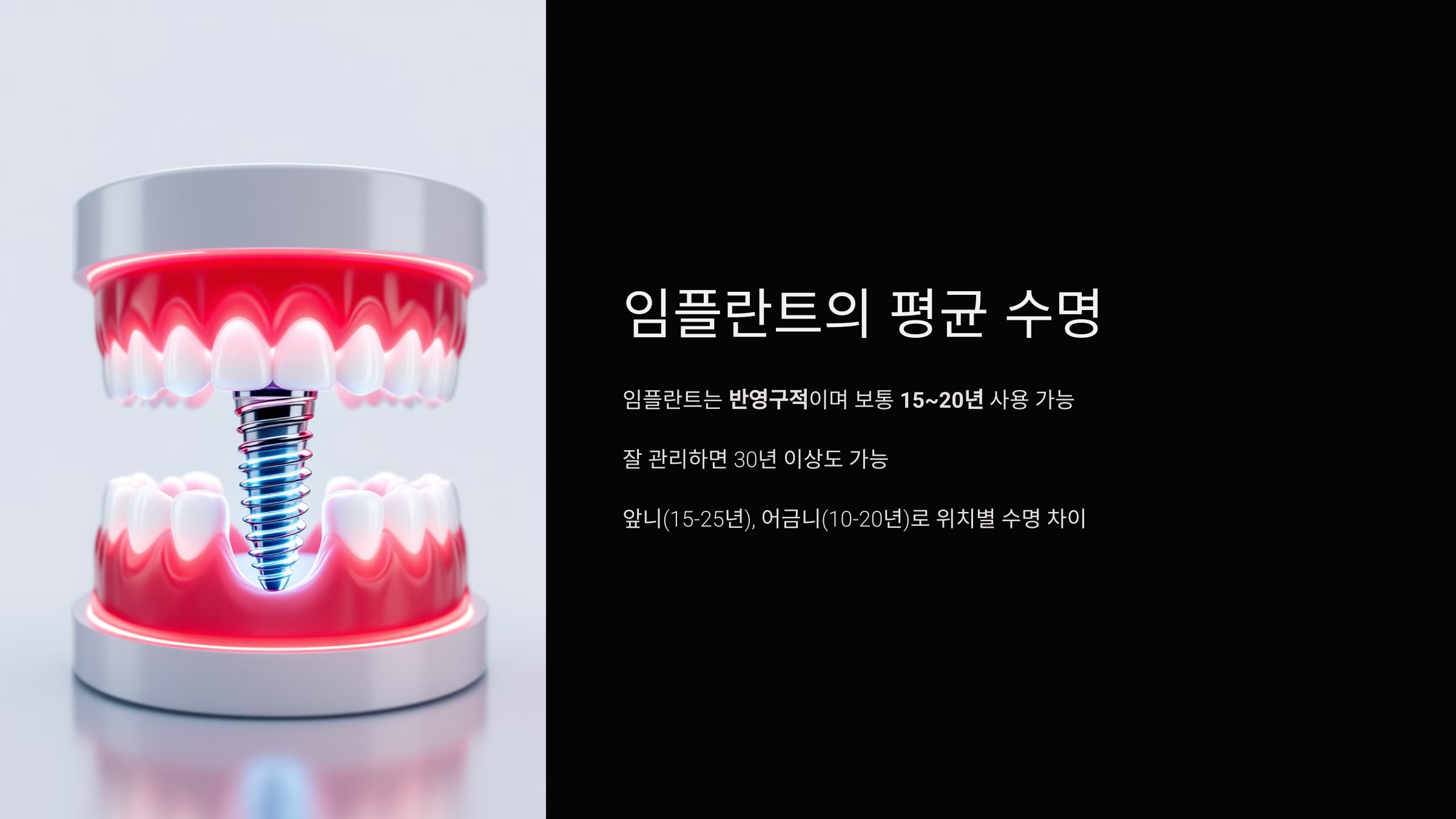 임플란트의 평균 수명