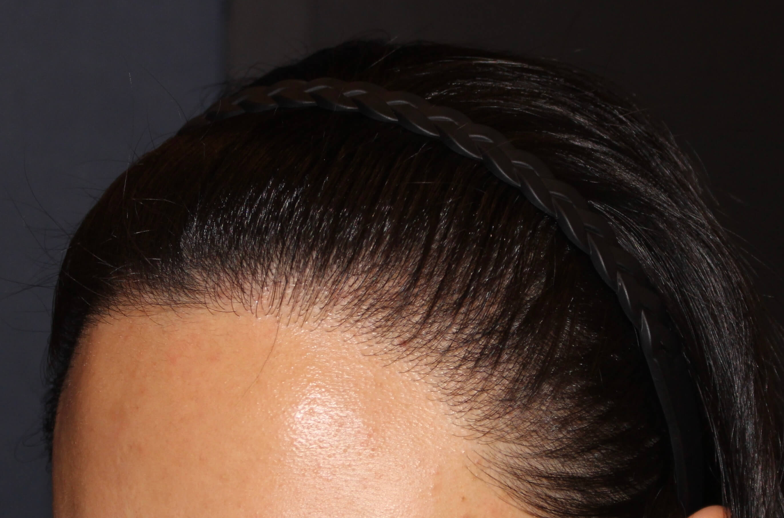 2차 보강 수술 좌측