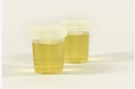 단백뇨 원인과 증상