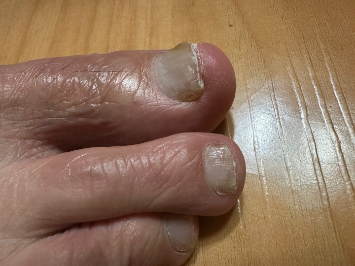 발톱무좀, 어떻게 치료해야 할까요? (병원 치료법)