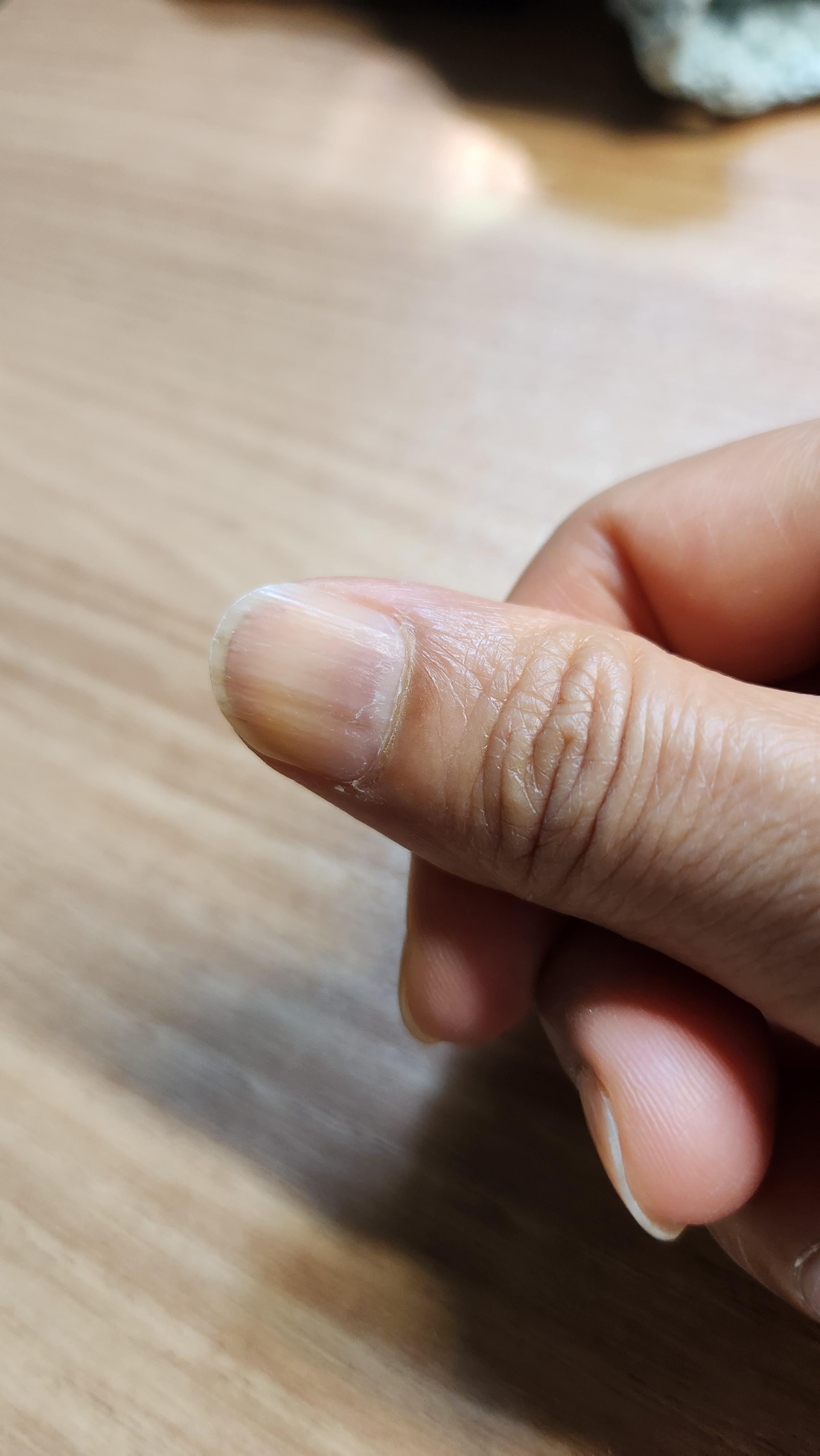 유방암 항암 부작용