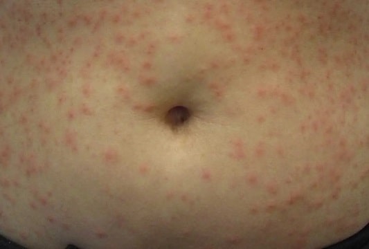 포도상 구균에 감염된 증상