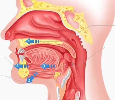 수면무호흡 기도확장수술