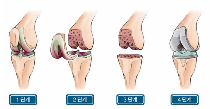 무릎인광관절수술