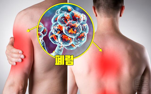 러닝 가슴통증 원인 폐렴 후유증