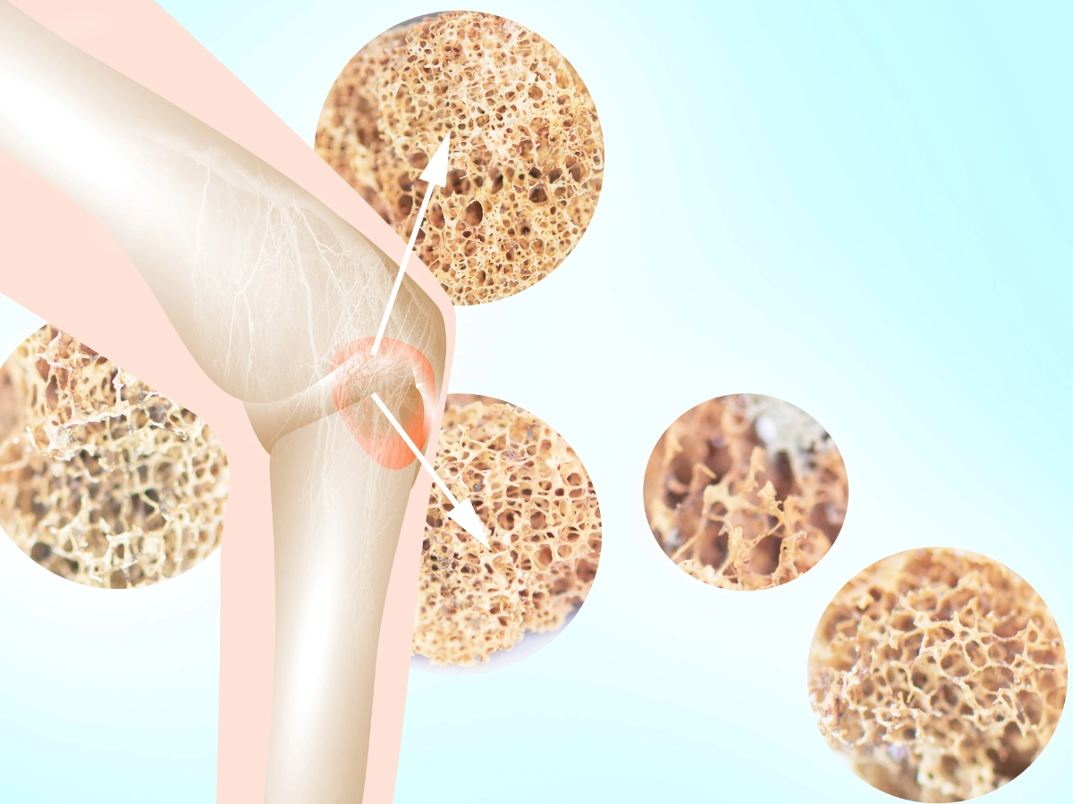 골밀도, 골강도