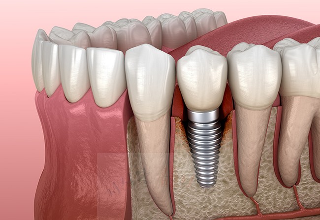 임플란트 이미지