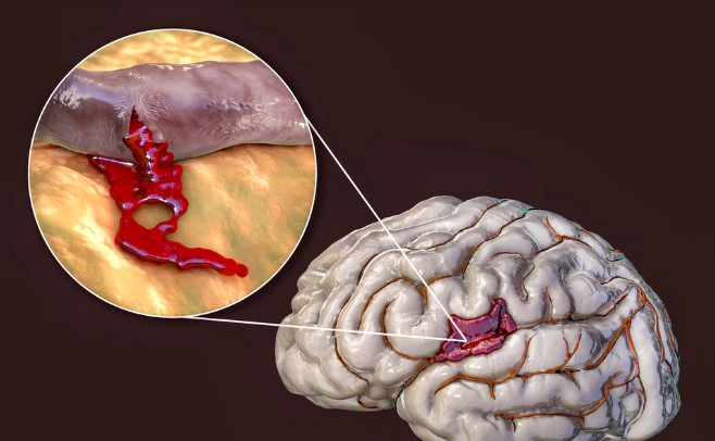 뇌출혈 수술 방법