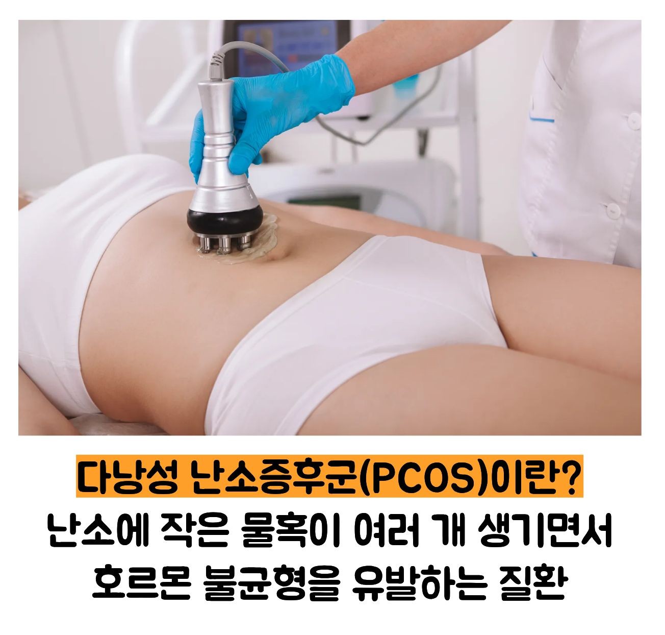 다낭성 난소 증후군 이란?