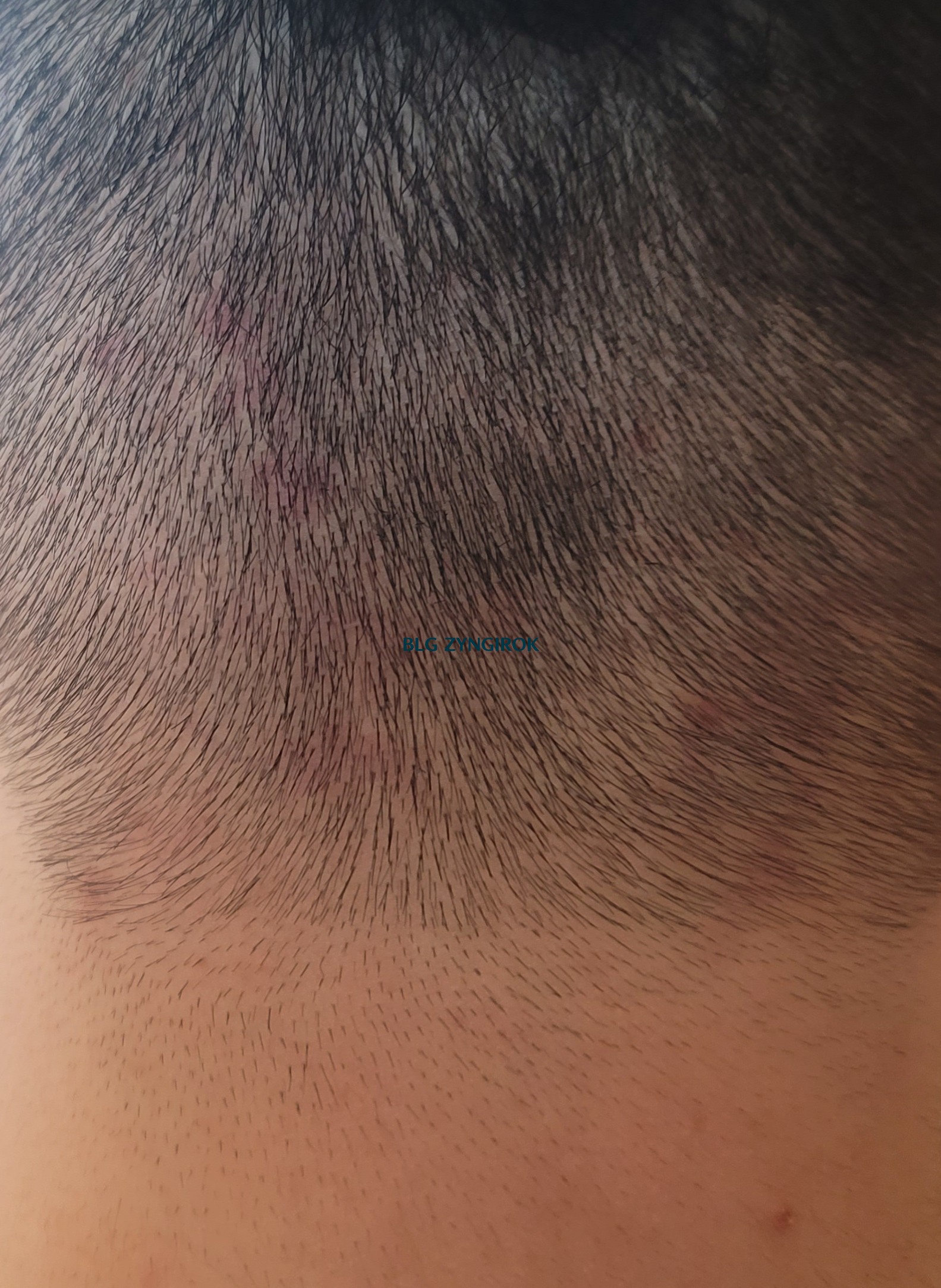 뒷머리 두피 모습이다. 울긋불긋 염증이 올라오고 있는 것을 확인할 수 있다.