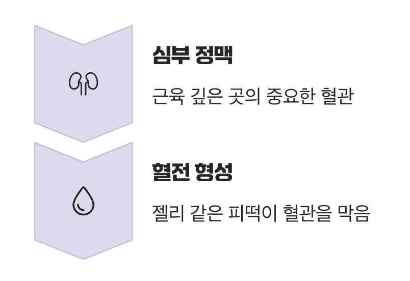 혈관 속에 생긴 '피떡', 혈전