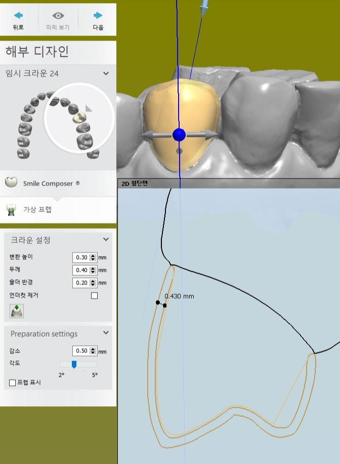 임시치아 두께 설정