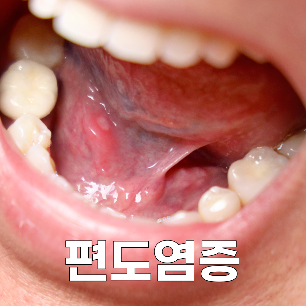 편도염증