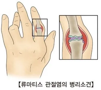 효과적인 류마티스 관절염 치료제 추천 약물 비교 가이드 2025 최신판_1