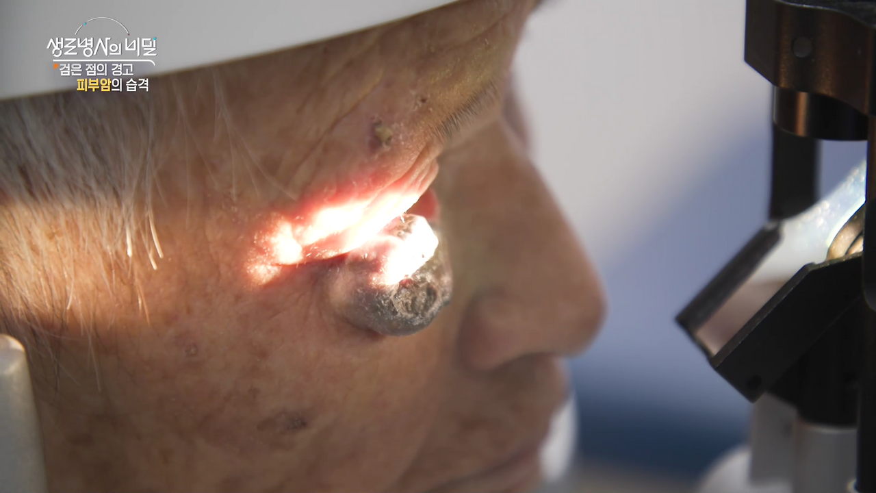 생로병사의 비밀 피부암 검은점