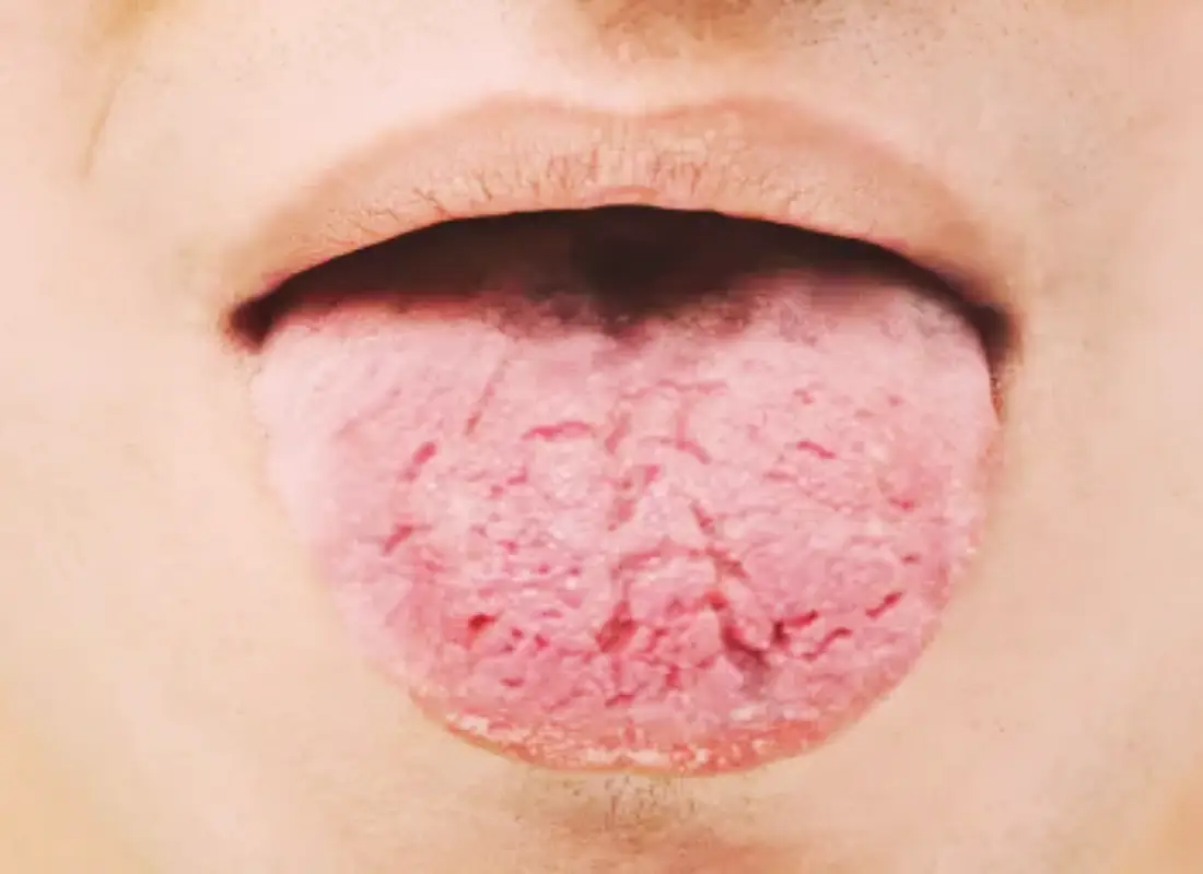 쇼그렌 증후군 사진