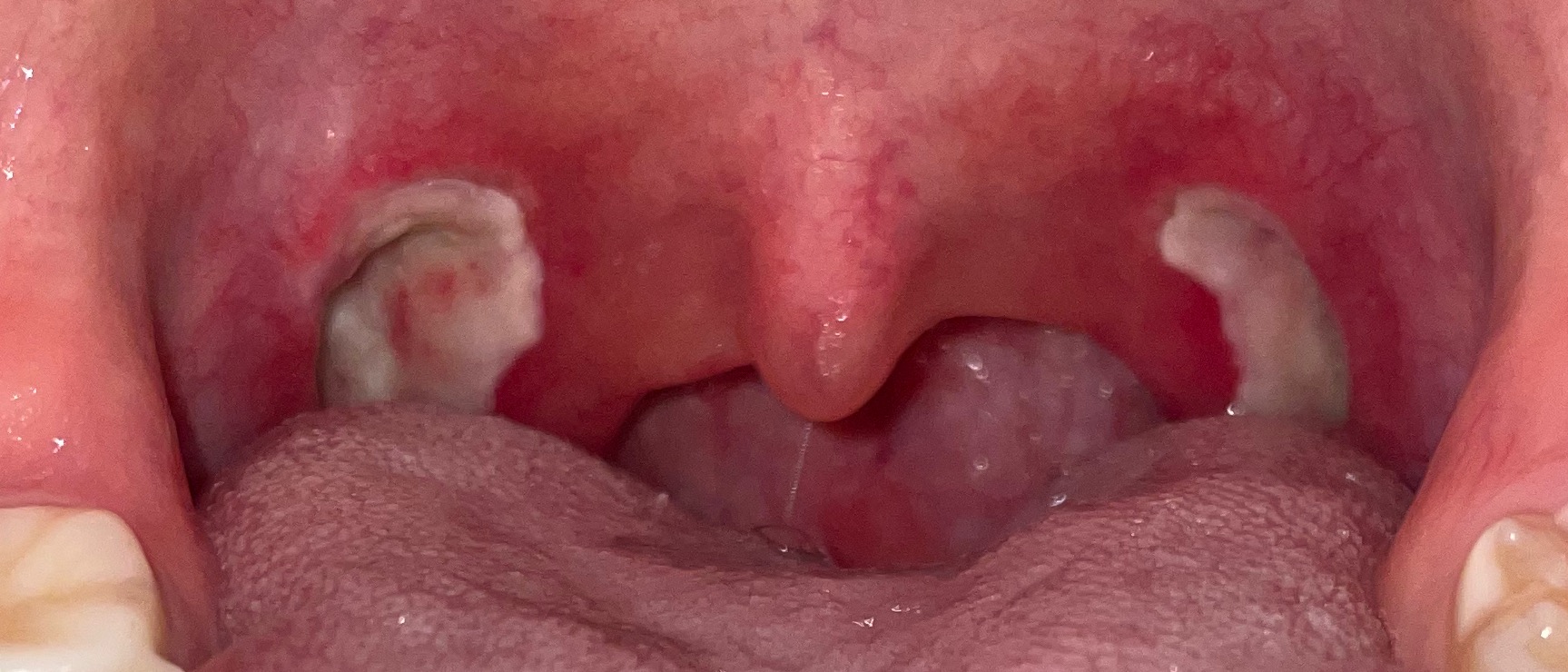 편도 절제 수술 3일차