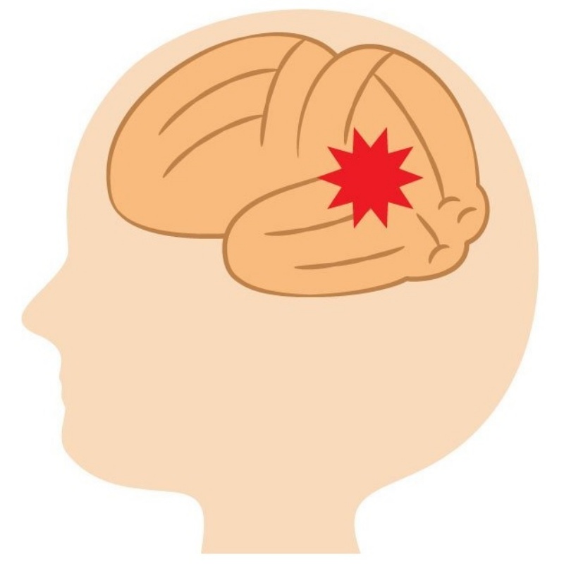 뇌졸중 초기 증상 좋은음식 사례