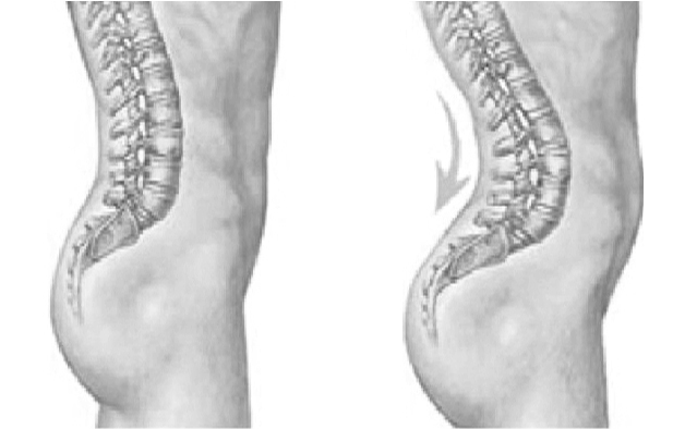 허리 꺾임&amp;#44; 과신전 사진