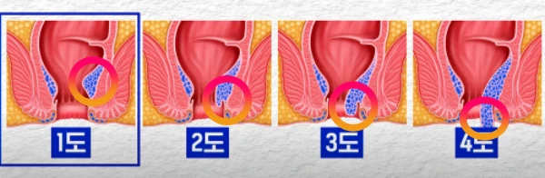 치질 단계