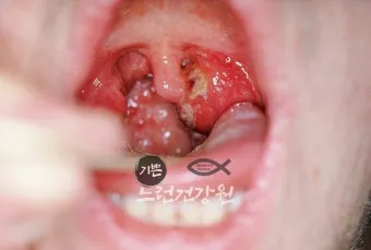 침 삼킬때 목아픔 코로나 증상인지 감별법_4