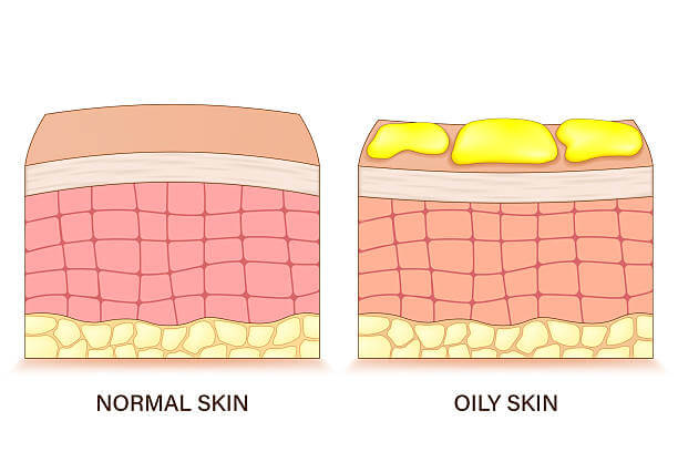 지성 피부 (Oily Skin)